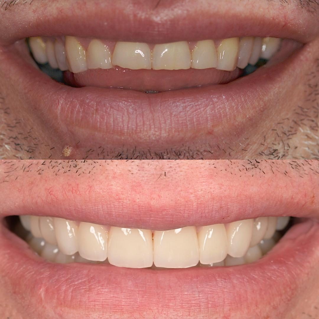 Sorriso prima e dopo il trattamento