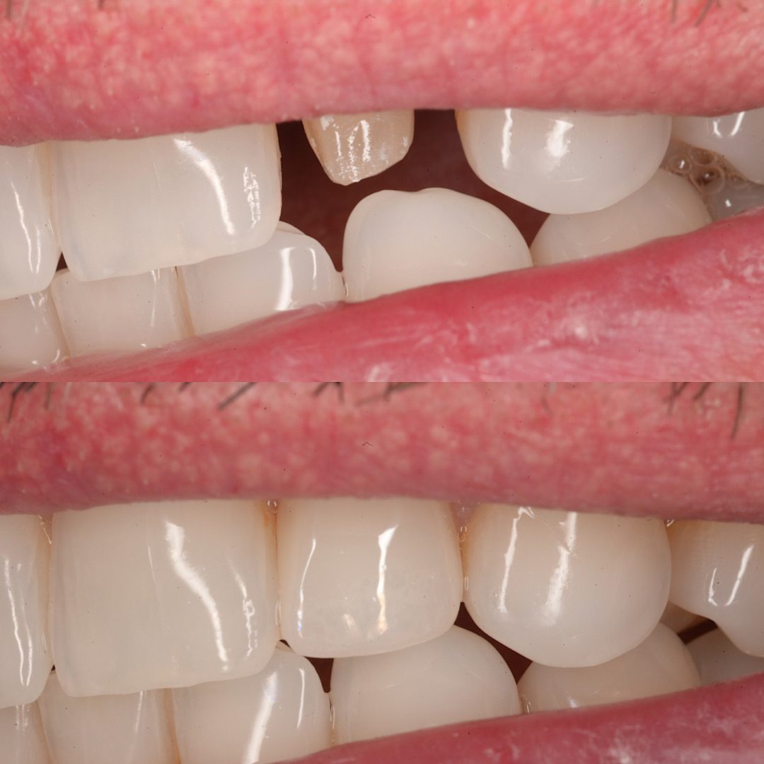 Denti anteriori prima e dopo la protesi